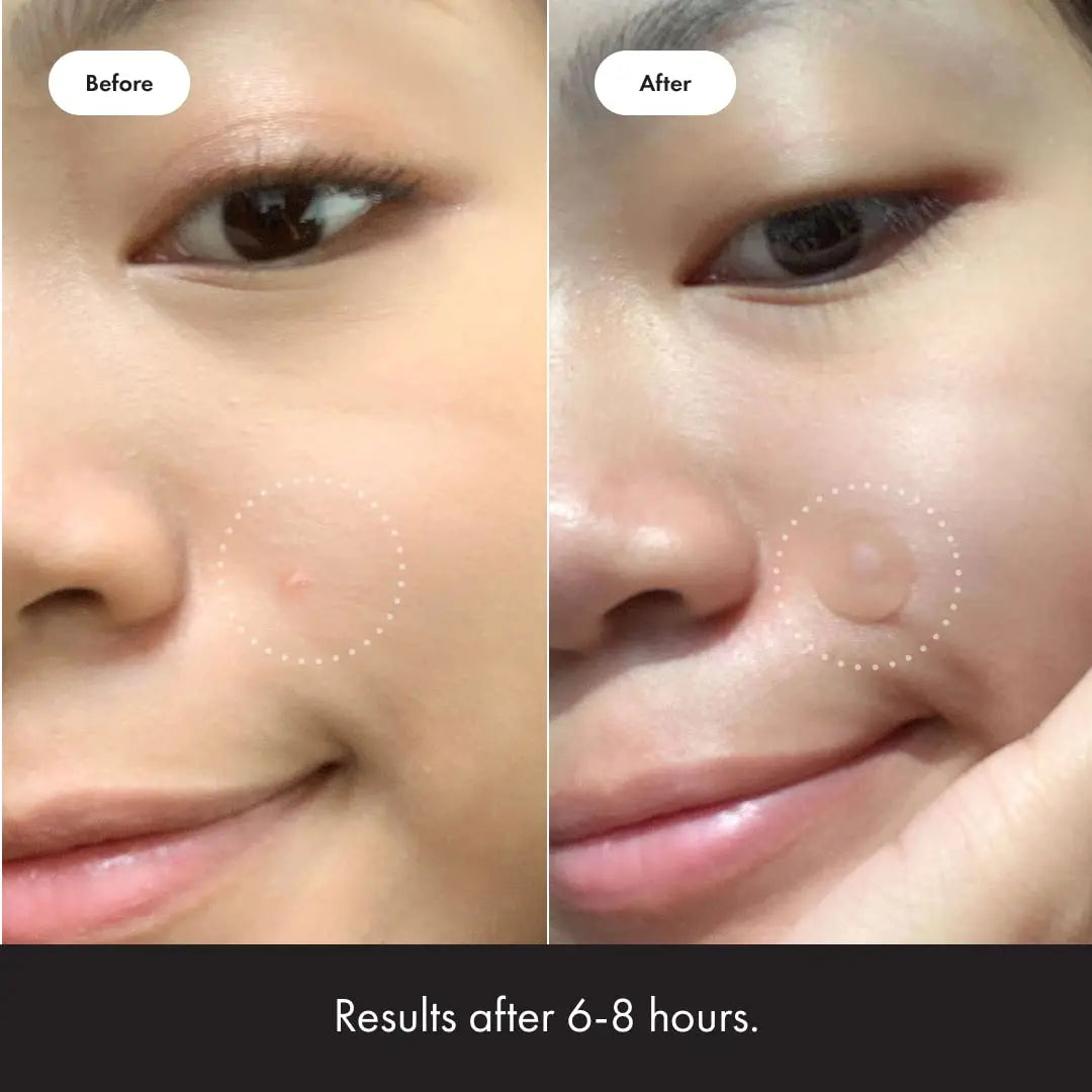 Mighty Patch Original – Acne Pimple Patches by Hero
