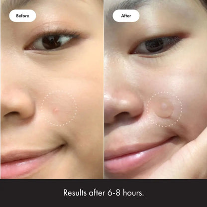 Mighty Patch Original – Acne Pimple Patches by Hero